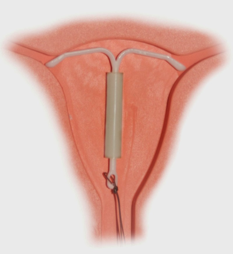 Mirena_IntraUterine_System.jpg
